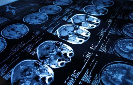 Alemães anunciam novo diagnóstico para Alzheimer