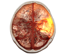 Siemens Healthineers recebe financiamento para avançar na robótica endovascular remota