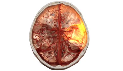 Siemens Healthineers recebe financiamento para avançar na robótica endovascular remota